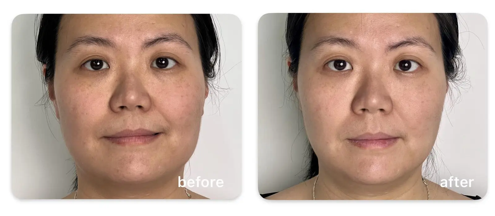 Facial de 35 años — antes/después, HERS V-HIFU + SonicPlex-F