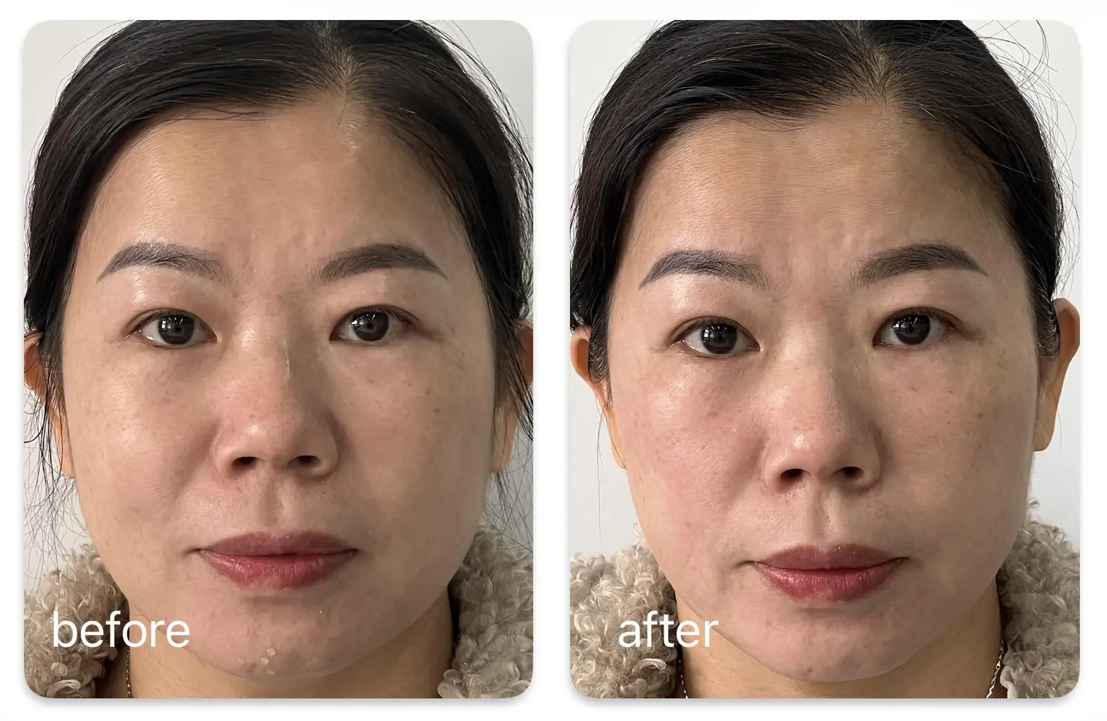 Facial de 37 años — antes/después, HERS V-HIFU + SonicPlex-F