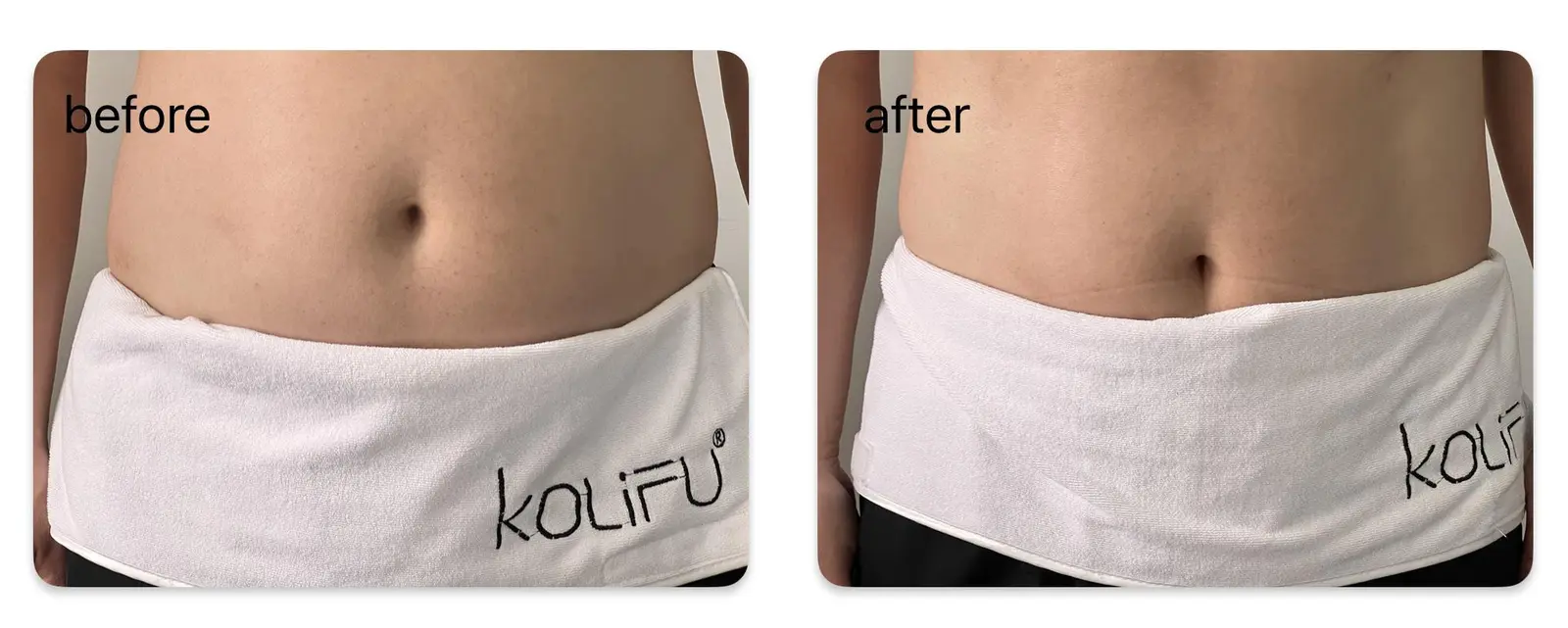 Remodelación corporal de 42 años — antes/después, HERS BodyShaper Pro