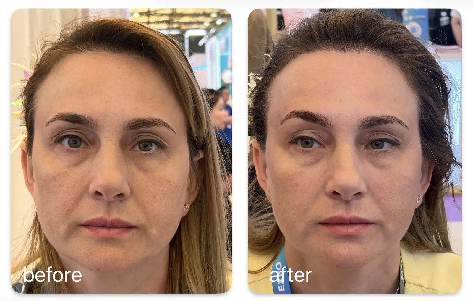Facial a los 43 años — antes/después, HERS V-HIFU