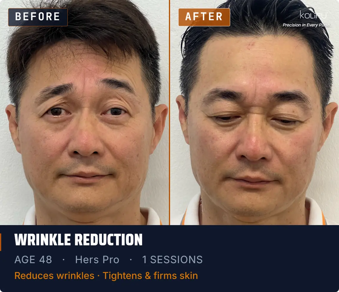 HERS PRO antes y después