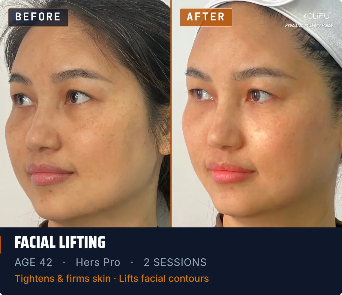 HERS PRO antes y después
