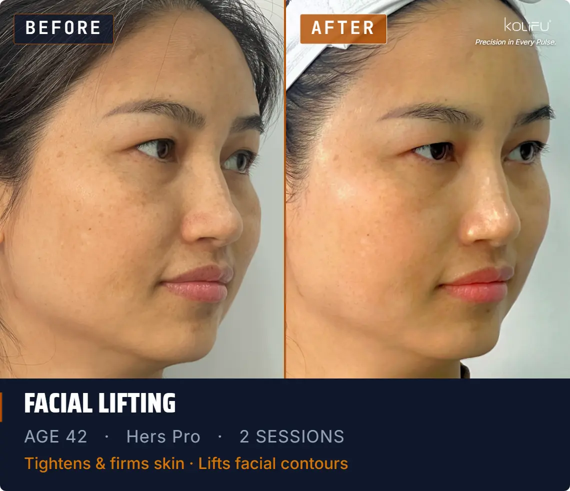 HERS PRO antes y después