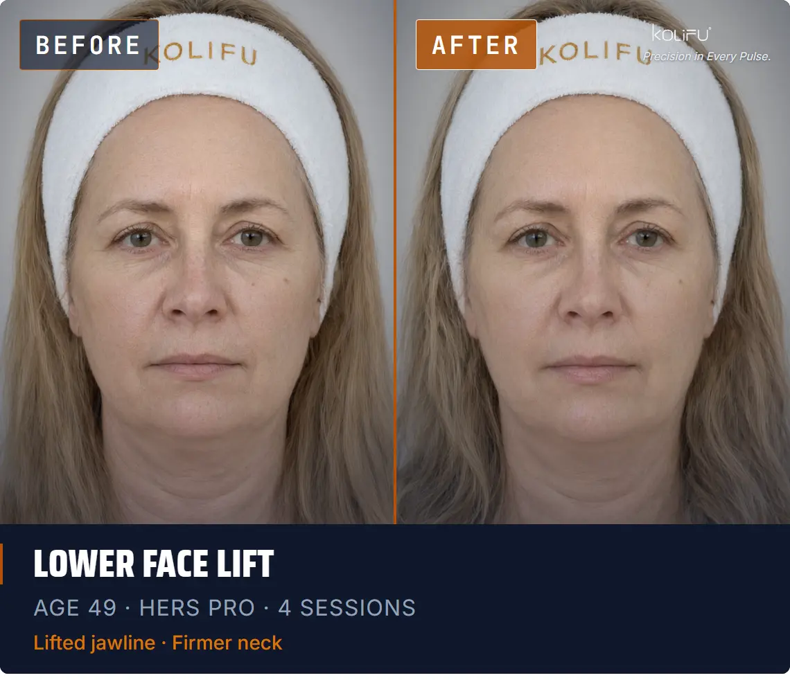 HERS PRO antes y después