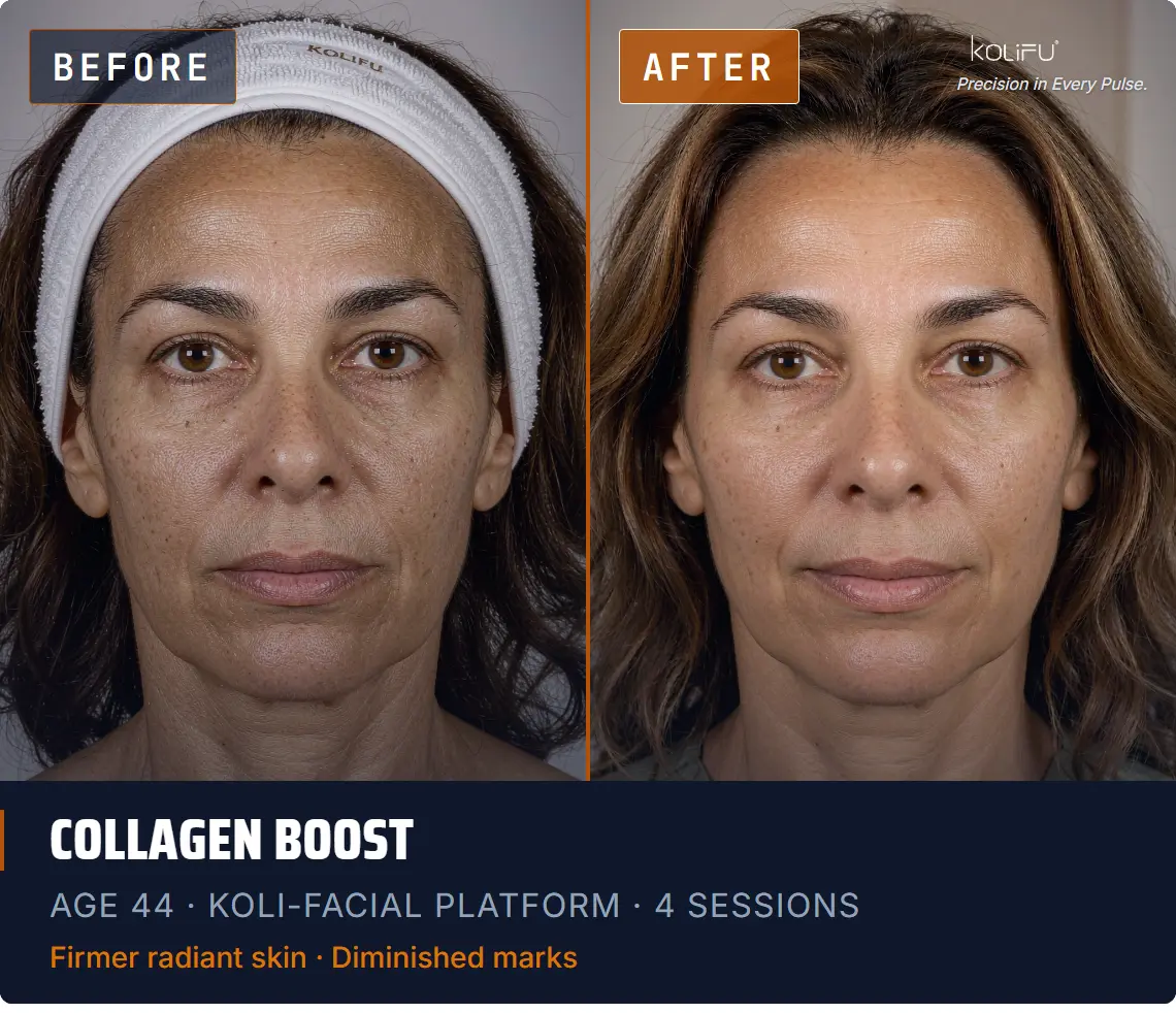 KOLI-FACIAL Hydro Dermabrasion Platform antes y después