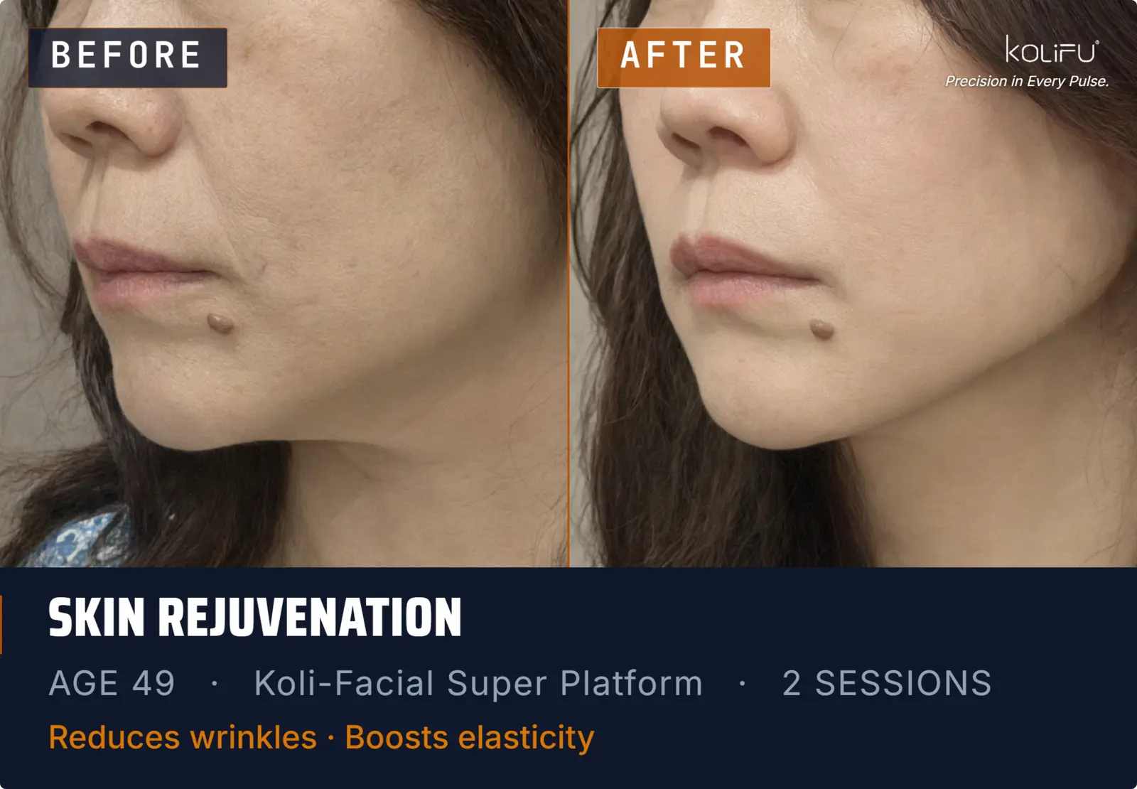 KOLI-FACIAL Hydro Dermabrasion Platform antes y después