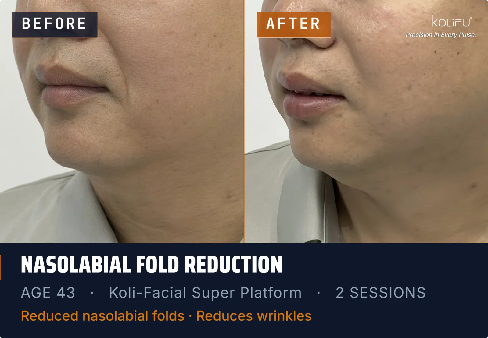 KOLI-FACIAL Hydro Dermabrasion Platform antes y después