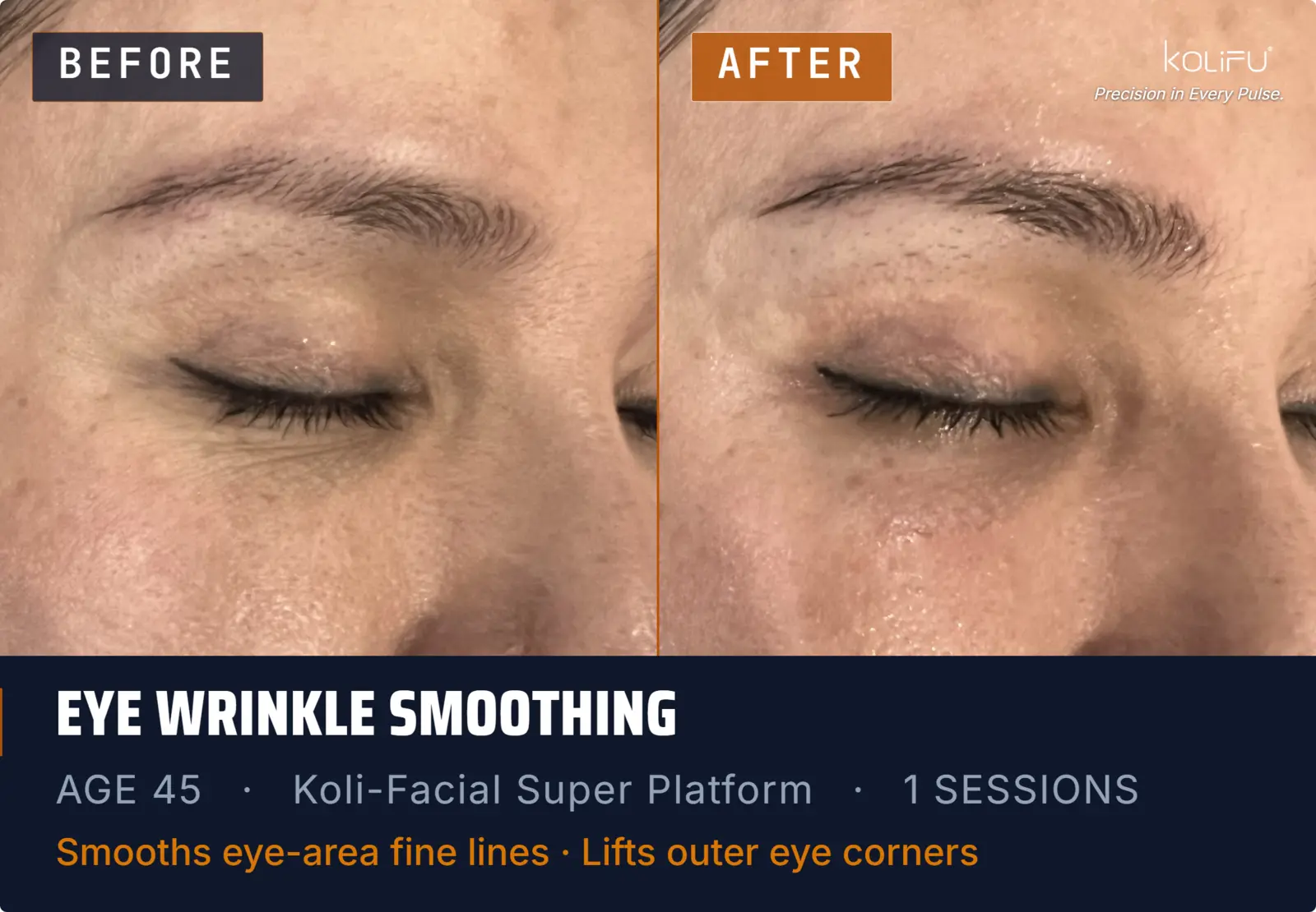 KOLI-FACIAL Hydro Dermabrasion Platform antes y después