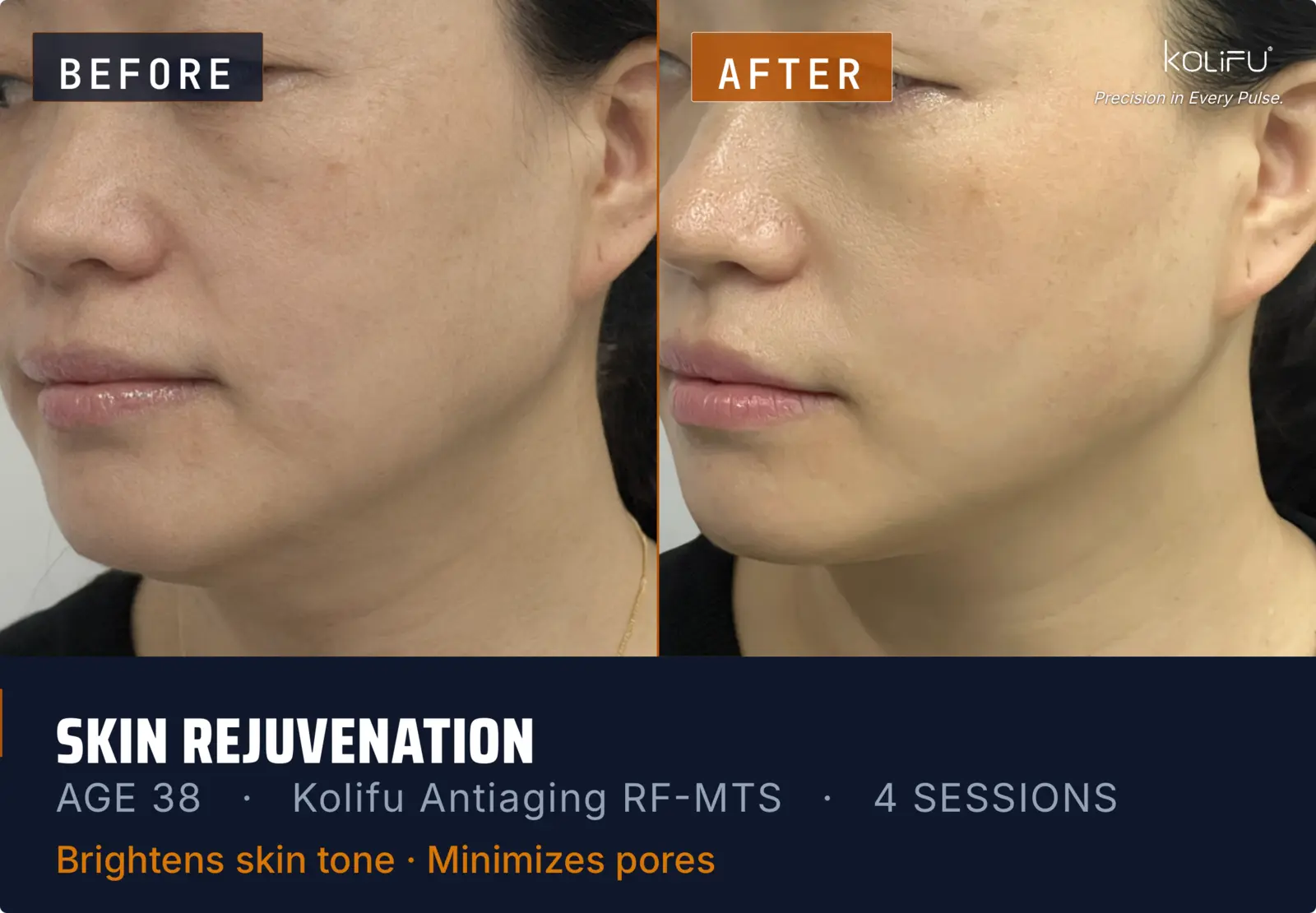 Kolifu Antiaging RF-MTS antes y después