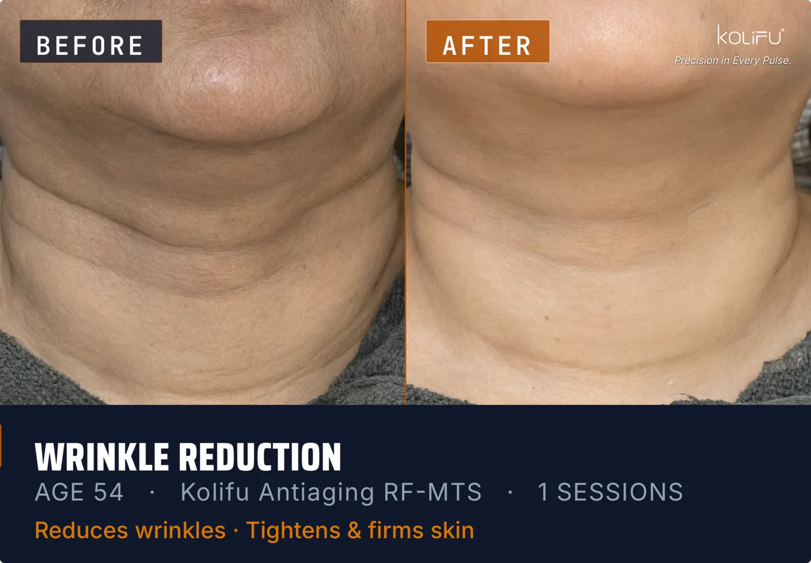 Kolifu Antiaging RF-MTS antes y después