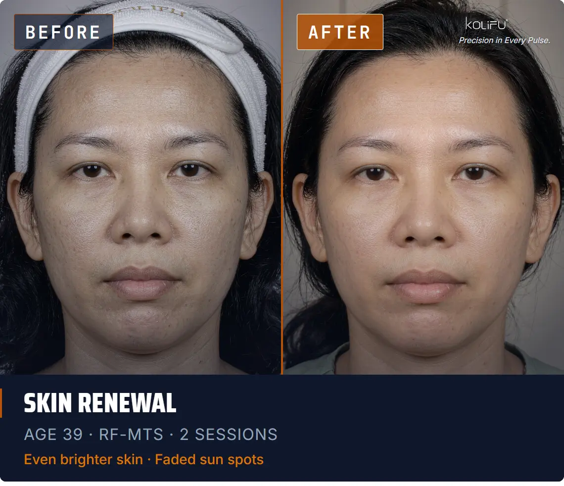 Kolifu Antiaging RF-MTS antes y después