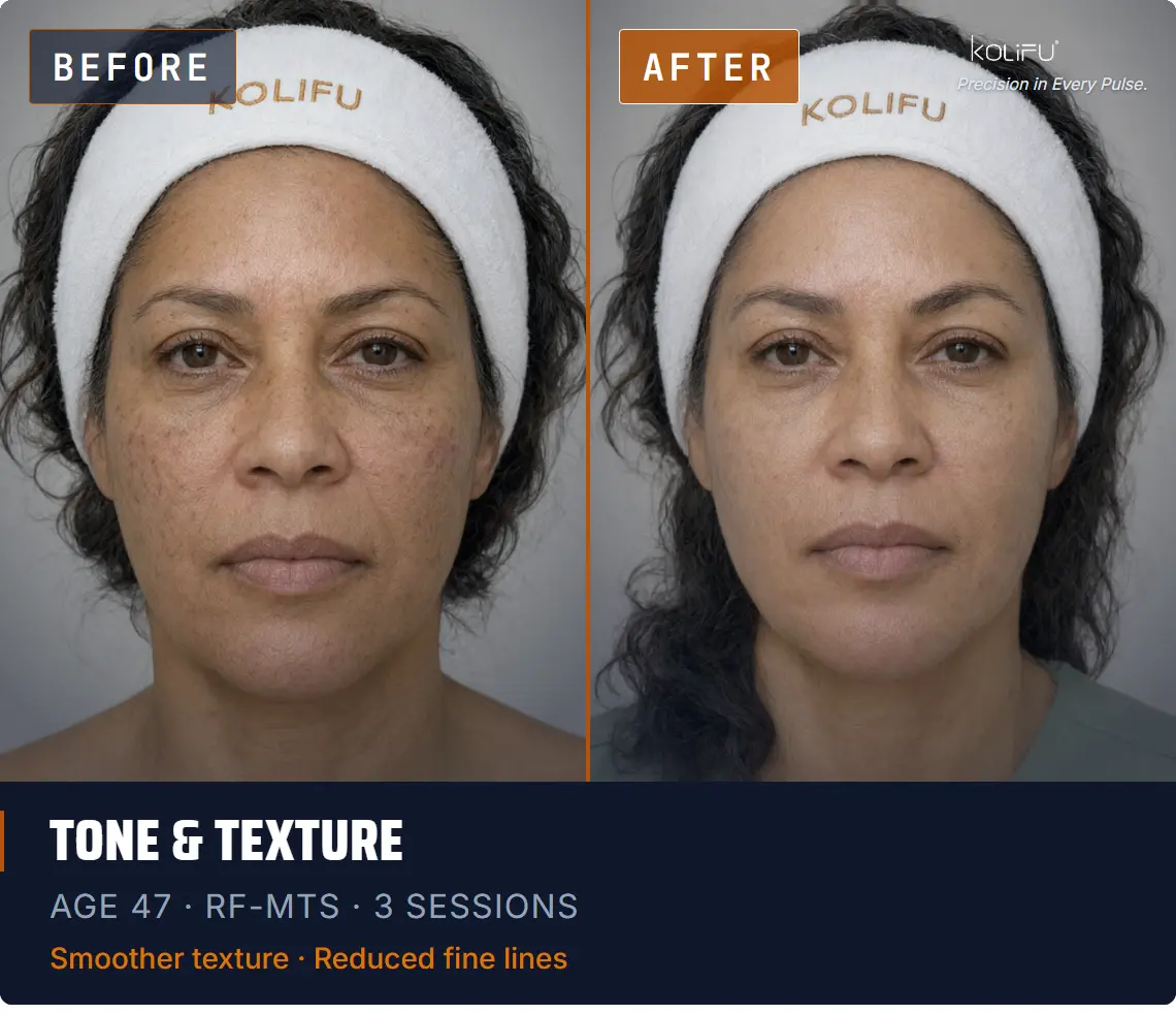 Kolifu Antiaging RF-MTS antes y después