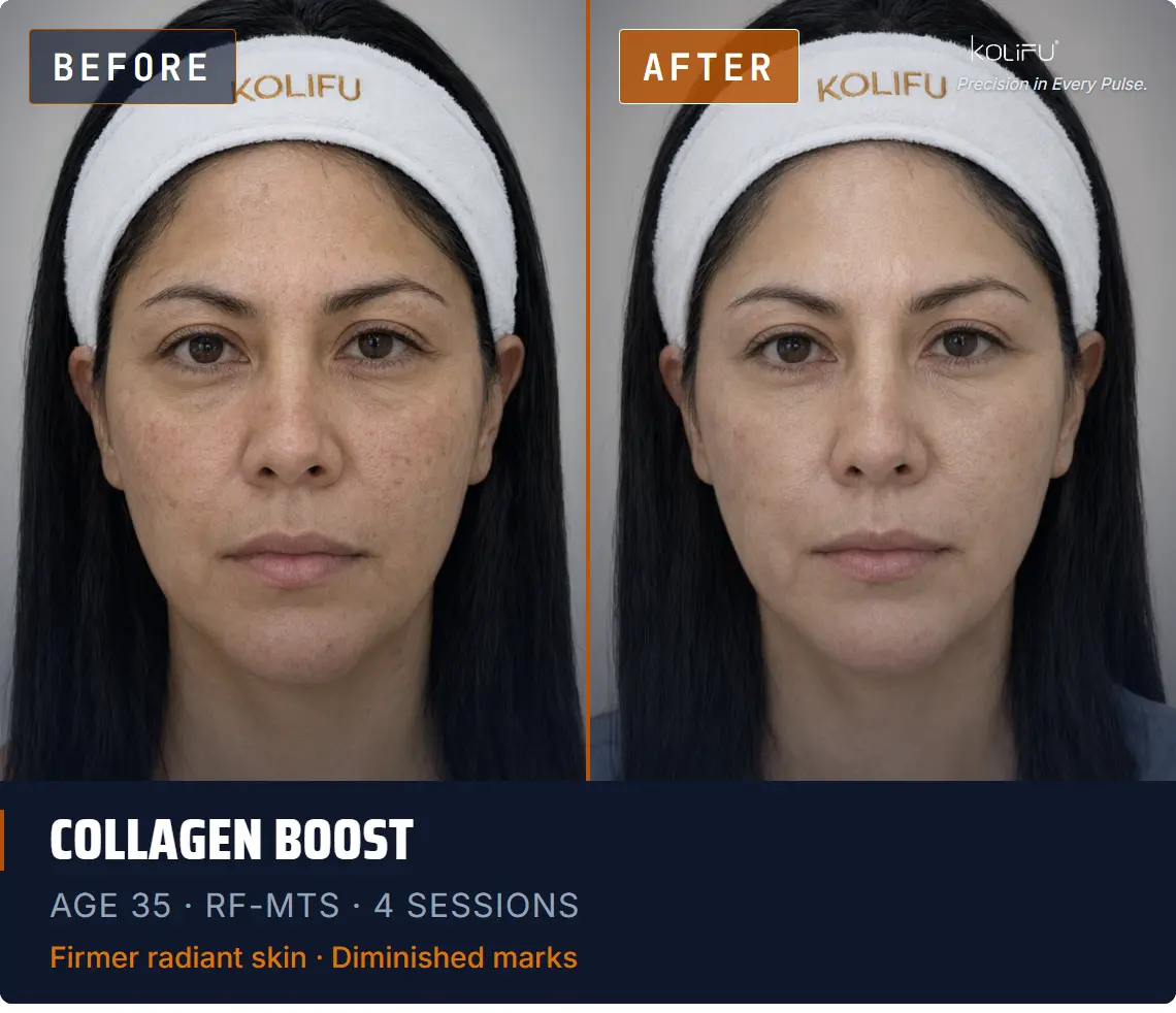 Kolifu Antiaging RF-MTS antes y después