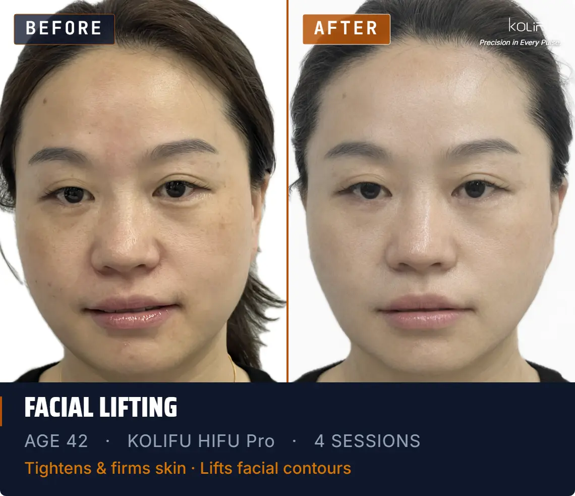KOLIFU HIFU PRO antes y después