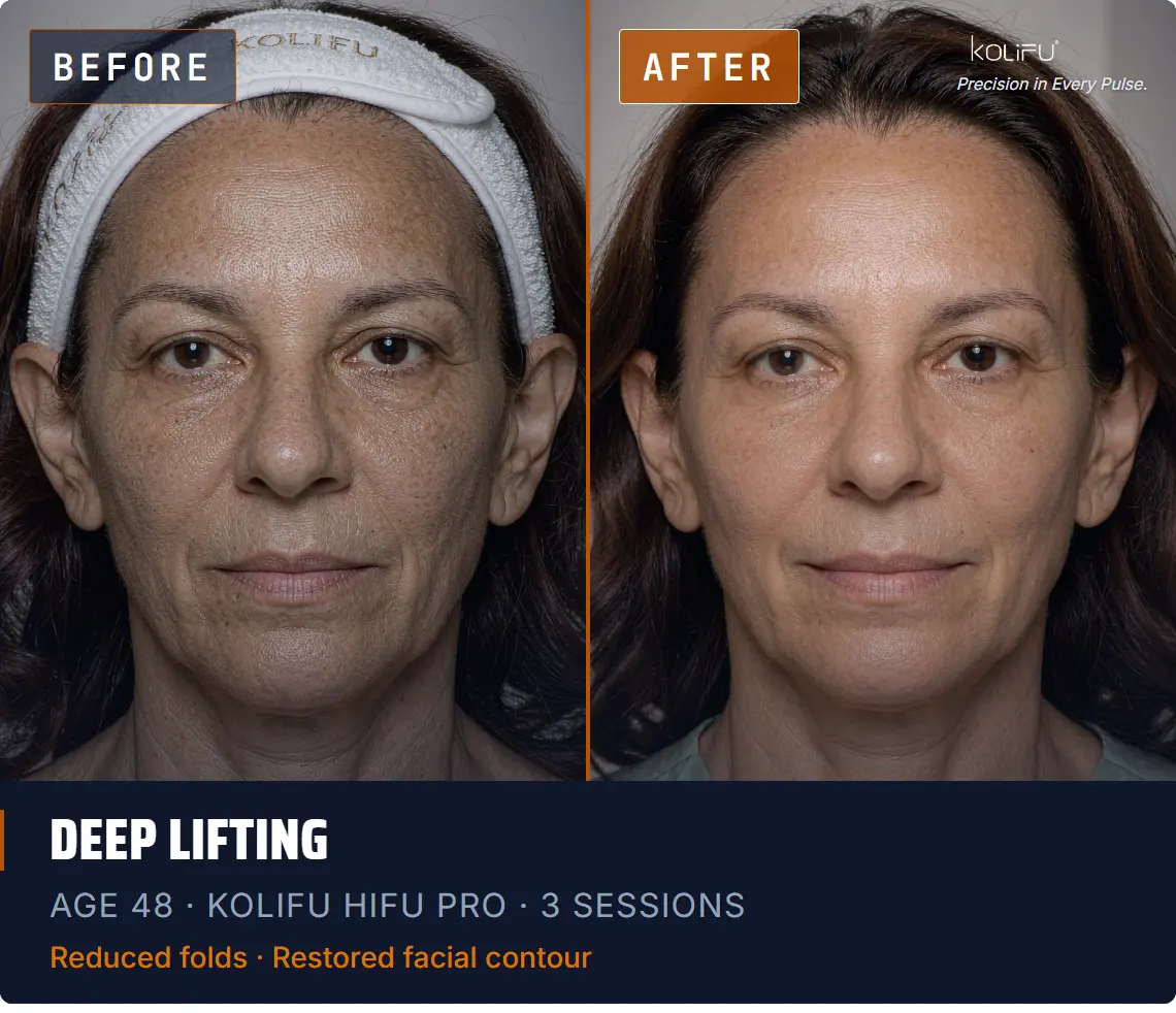 KOLIFU HIFU PRO antes y después