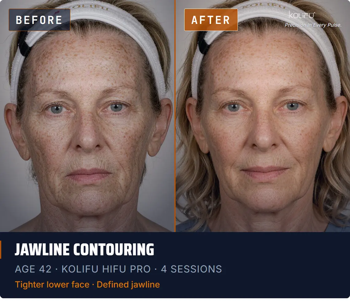 KOLIFU HIFU PRO antes y después
