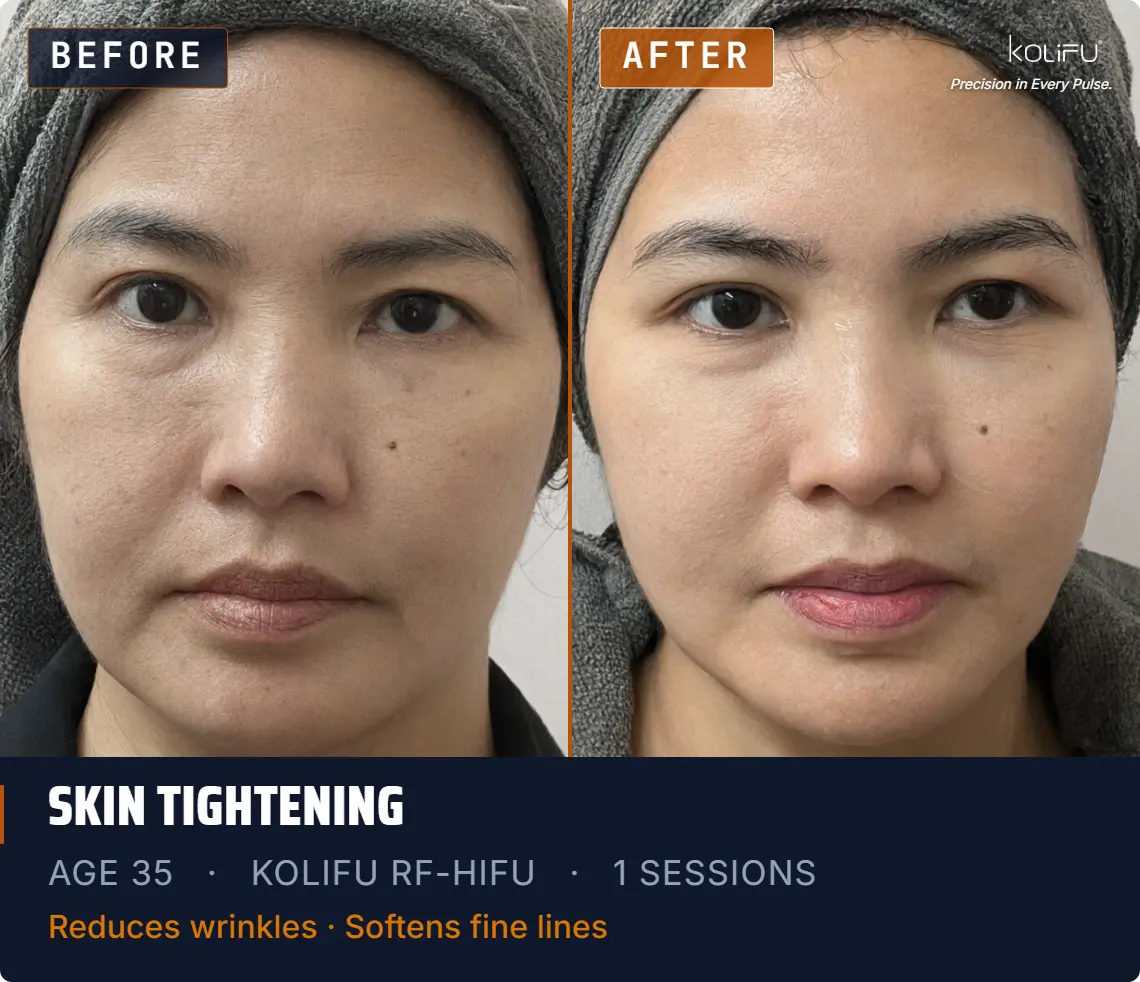 KOLIFU RF-HIFU antes y después