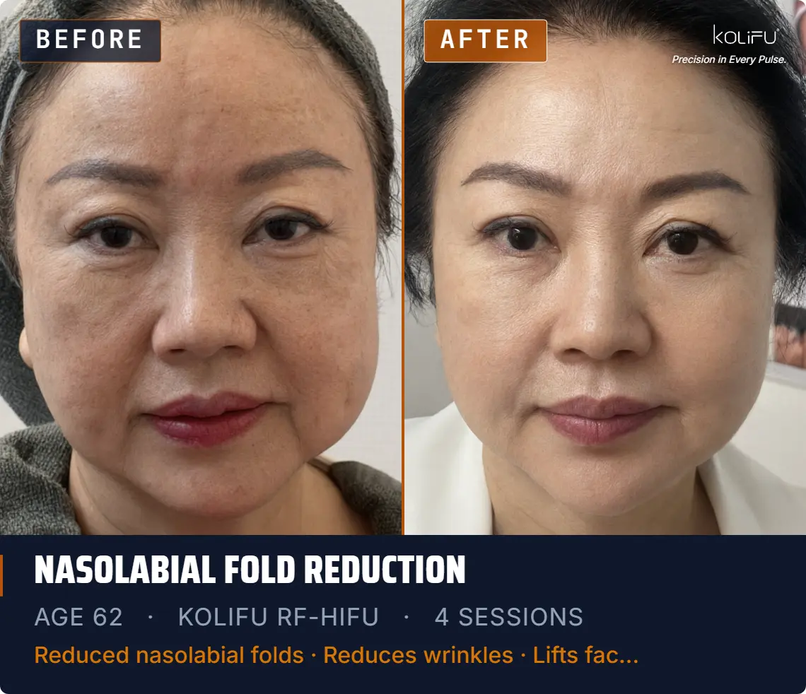 KOLIFU RF-HIFU antes y después