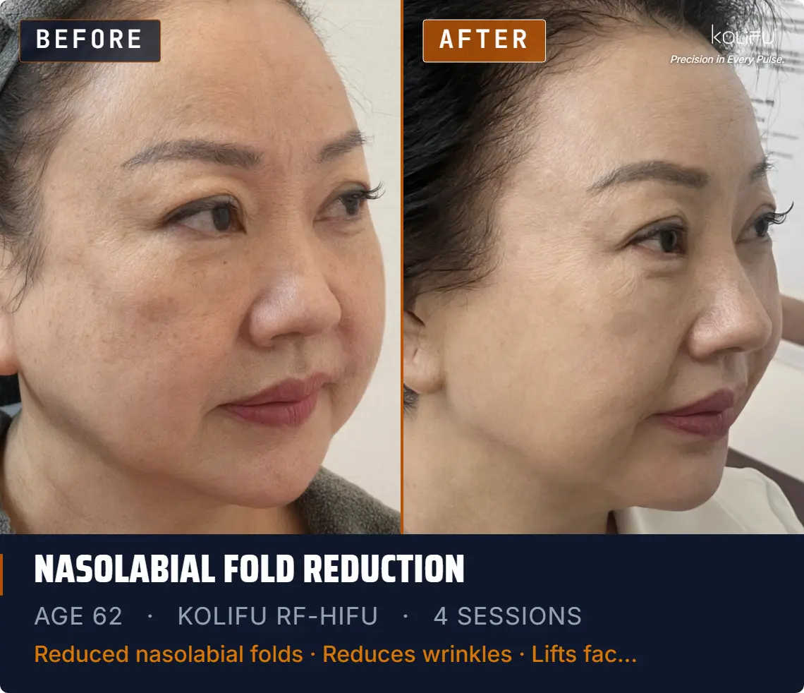 KOLIFU RF-HIFU antes y después