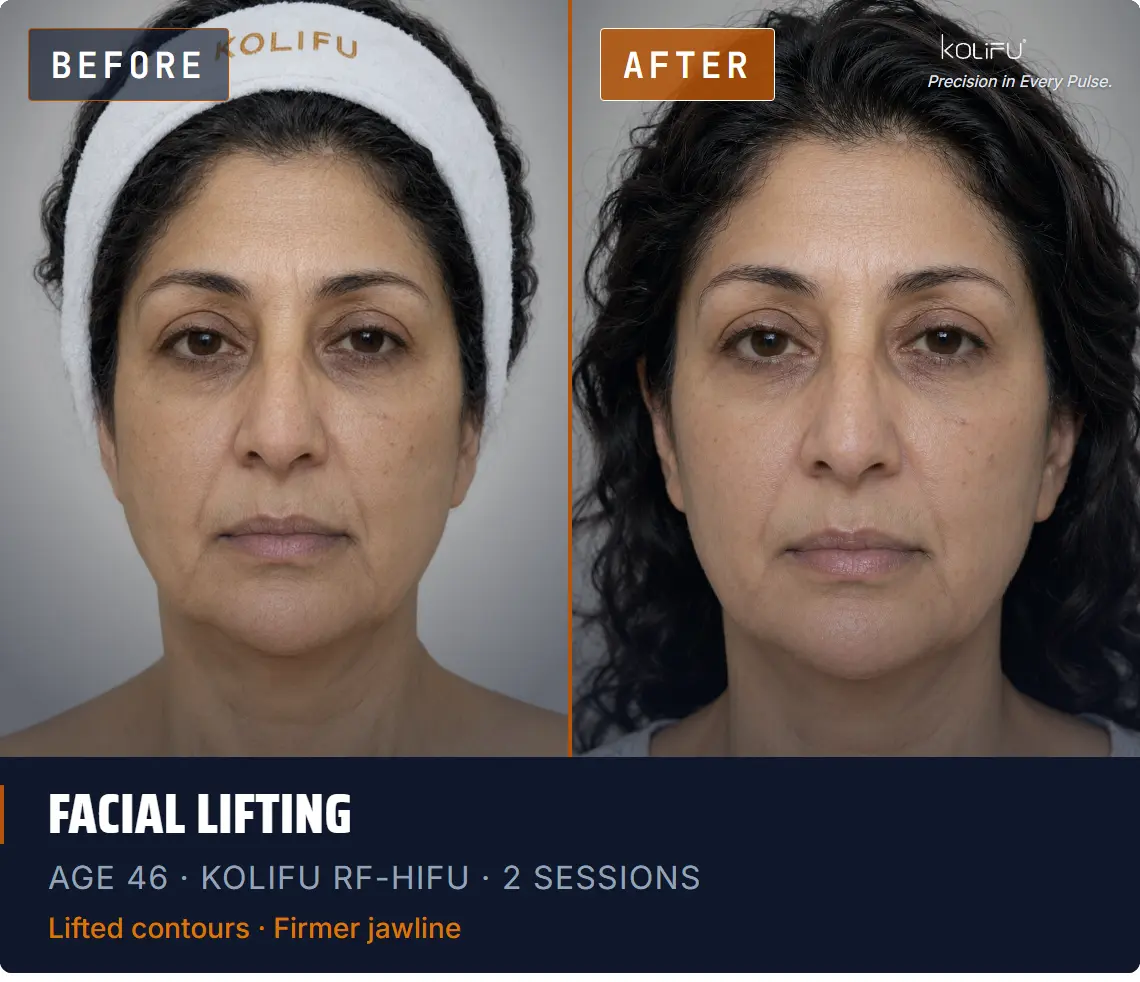 KOLIFU RF-HIFU antes y después
