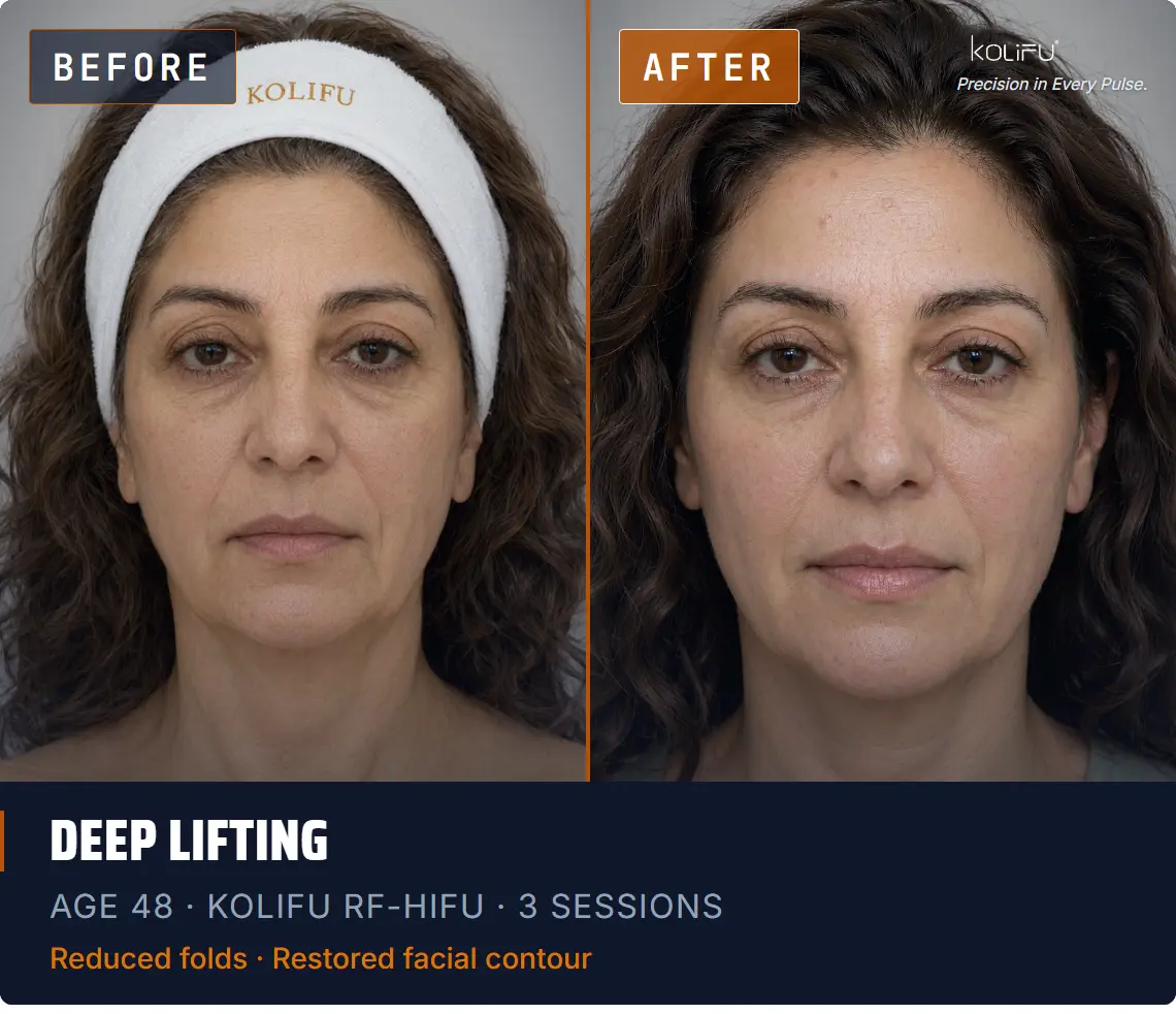 KOLIFU RF-HIFU antes y después