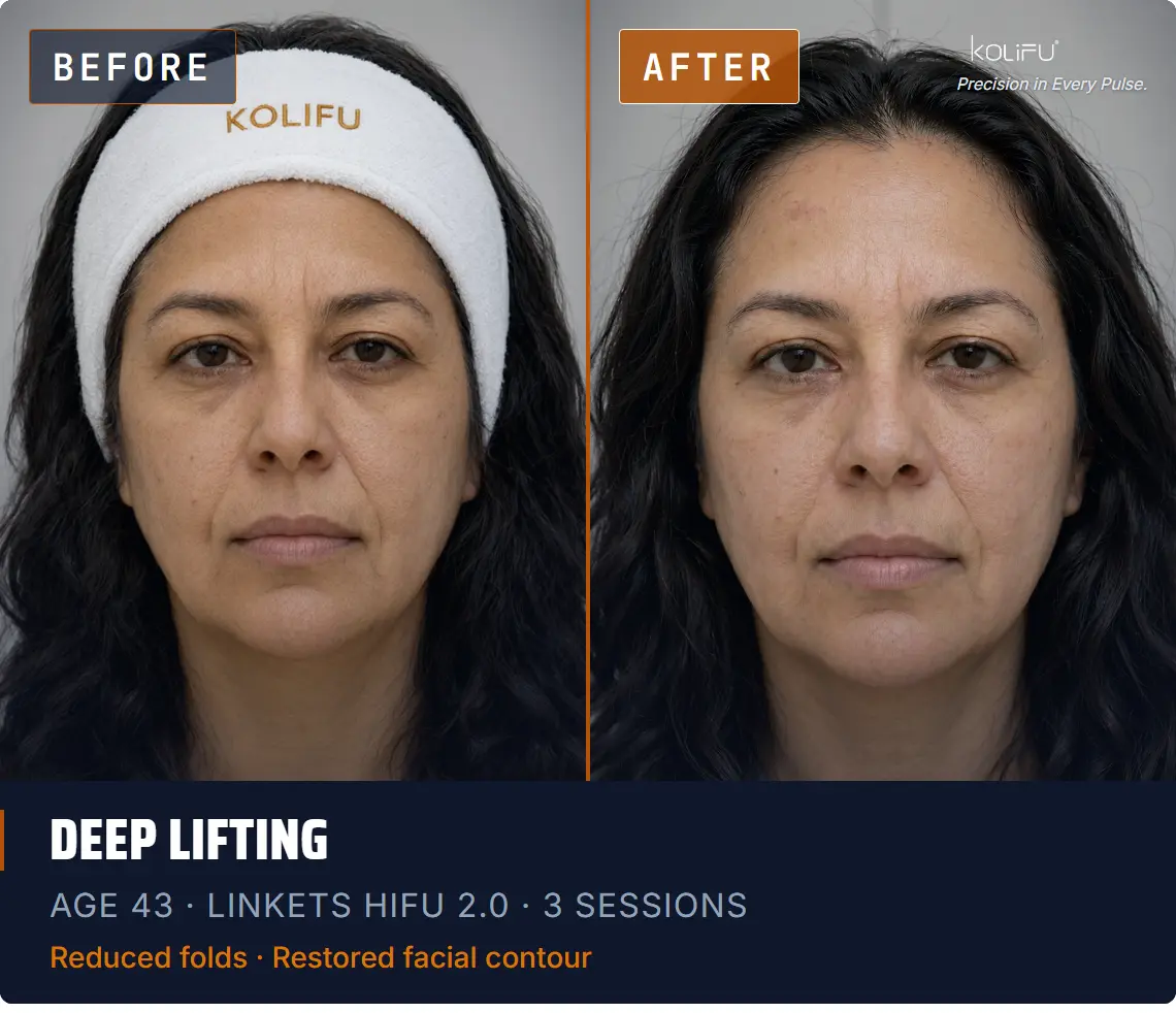 LINKETS HIFU 2.0 antes y después