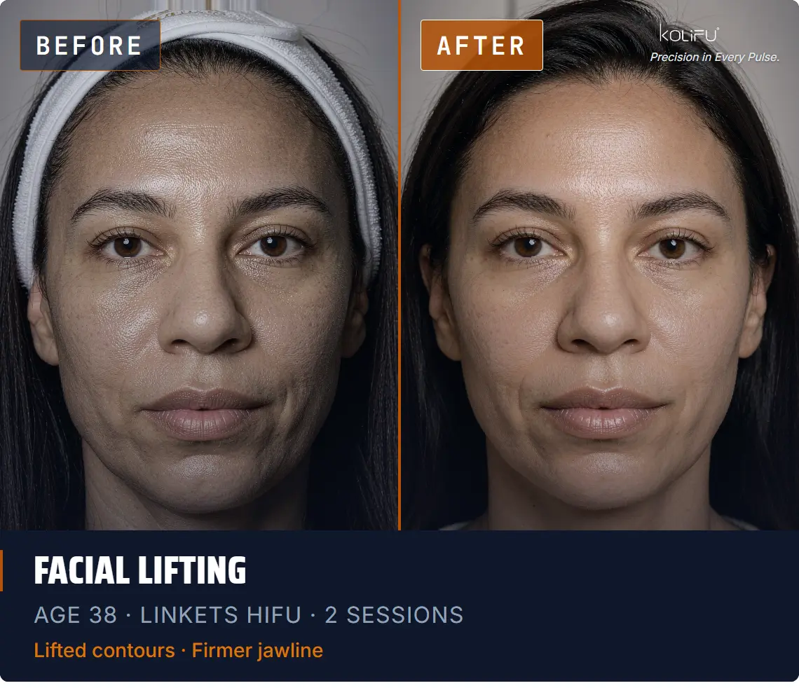 LINKETS HIFU antes y después