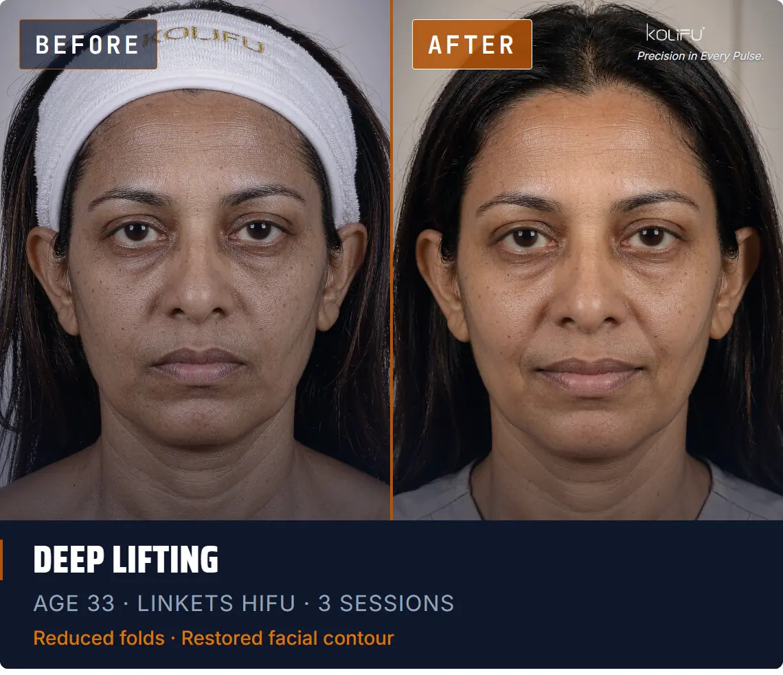 LINKETS HIFU antes y después