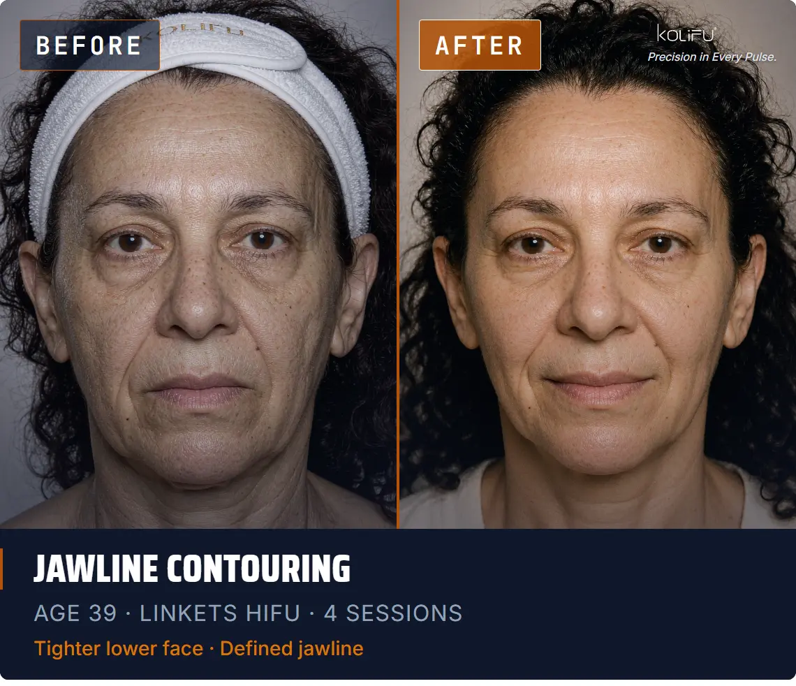 LINKETS HIFU antes y después