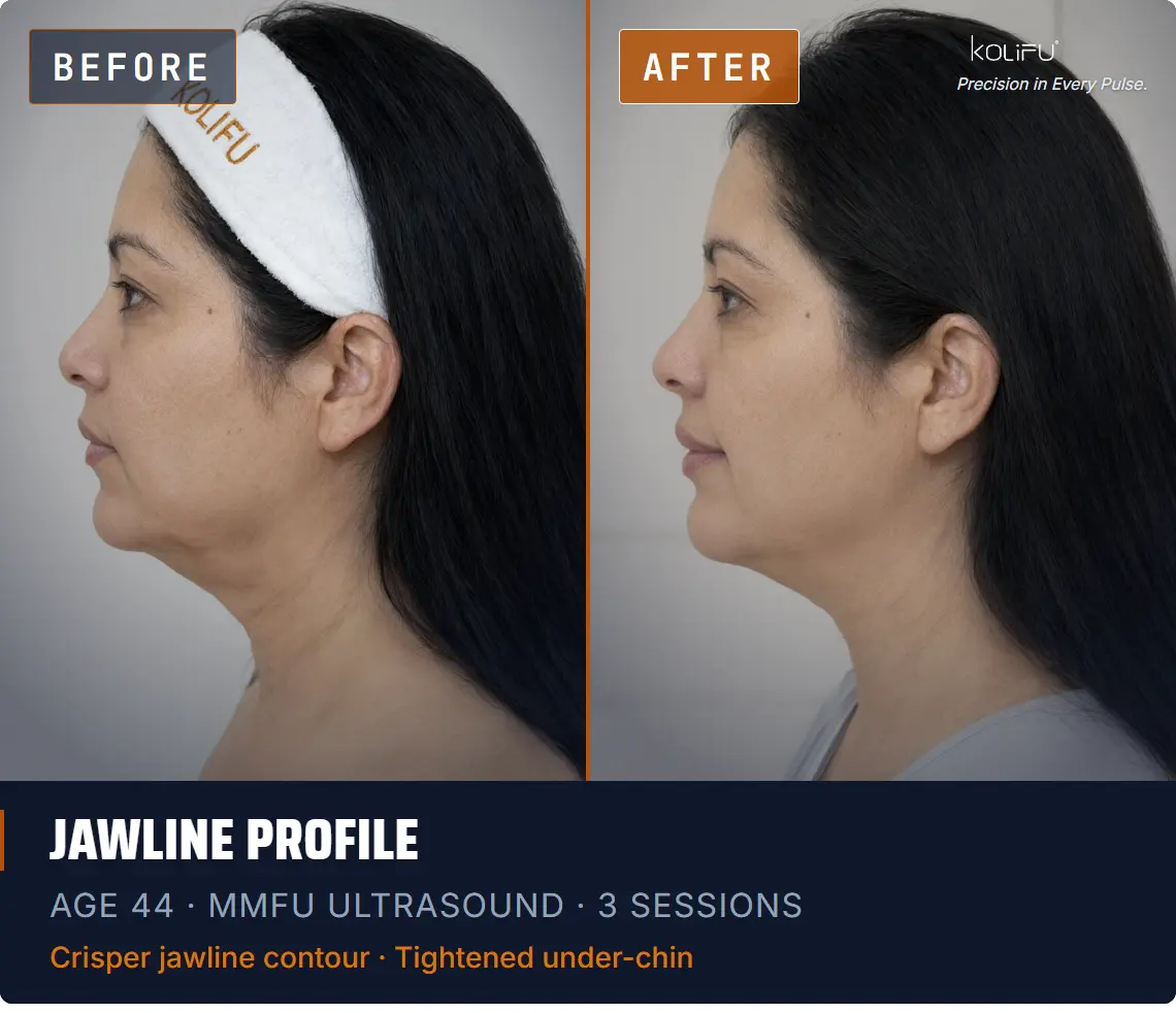 MMFU ULTRASOUND antes y después
