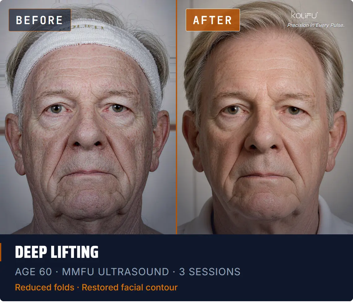 MMFU ULTRASOUND antes y después