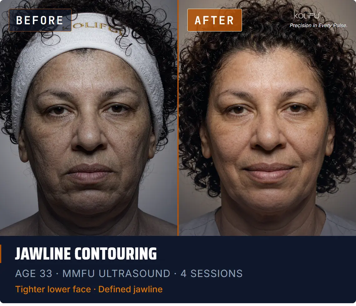 MMFU ULTRASOUND antes y después