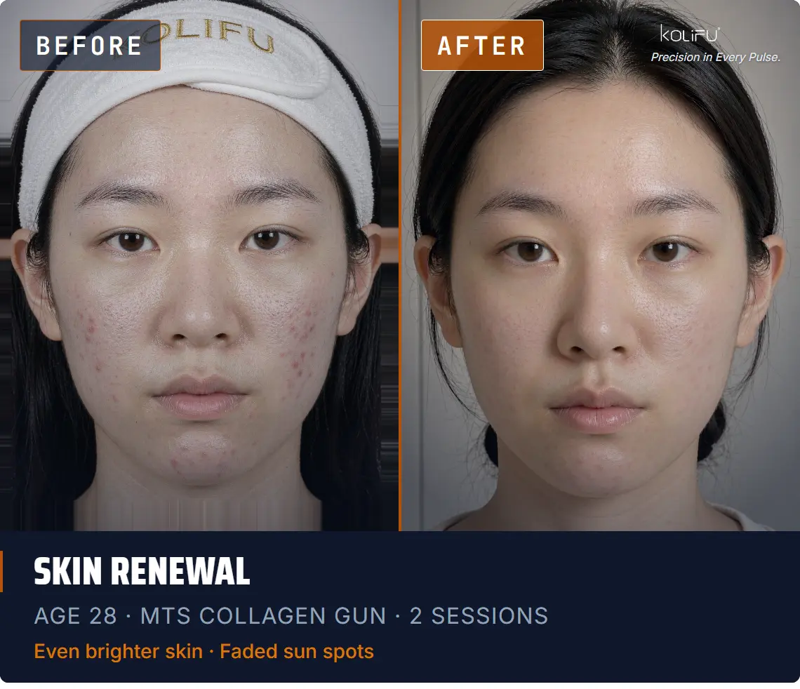 MTS Collagen Gun antes y después