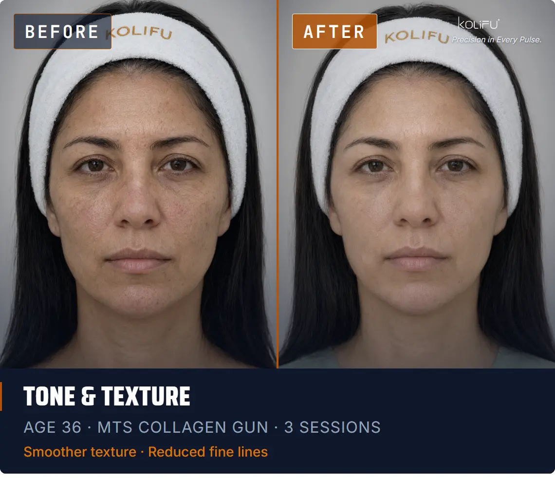 MTS Collagen Gun antes y después