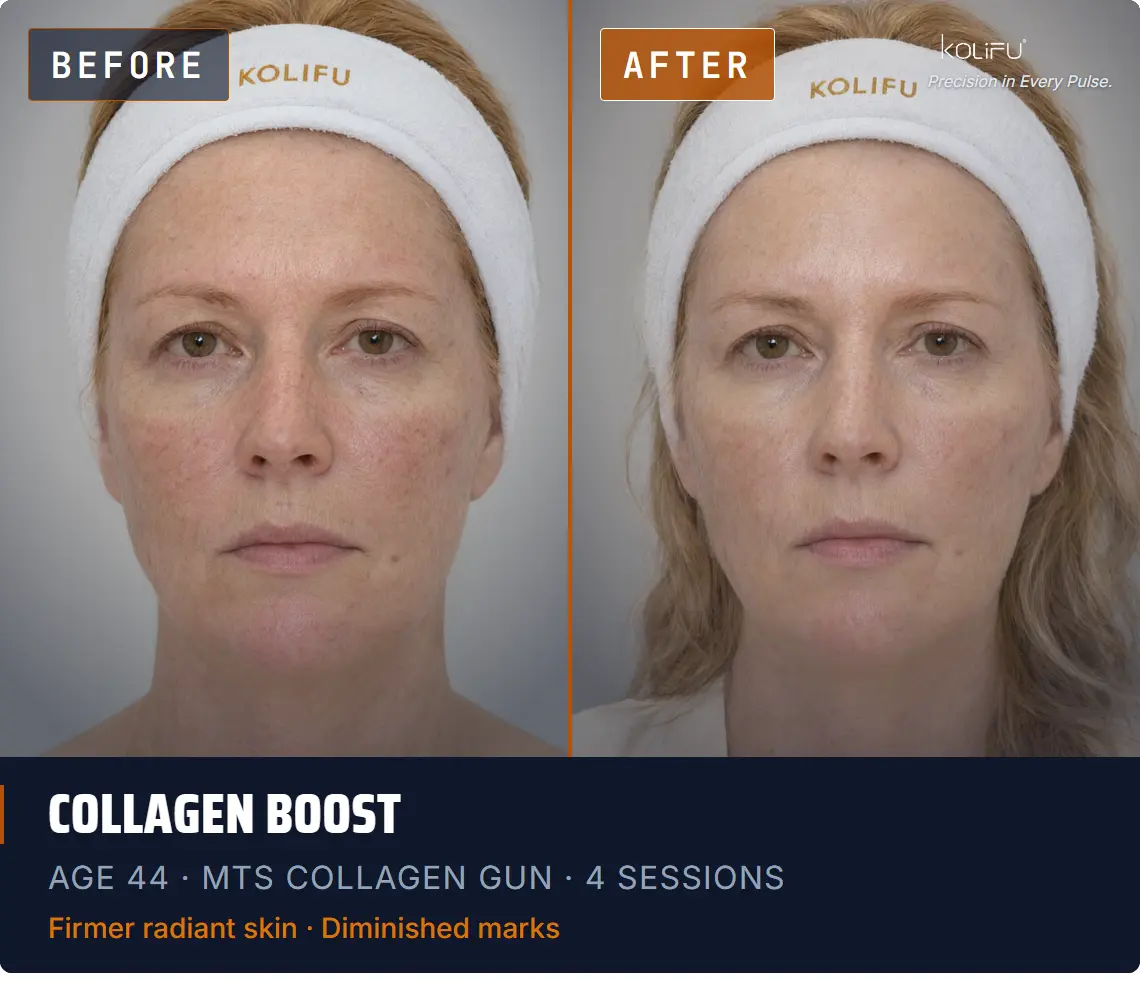 MTS Collagen Gun antes y después