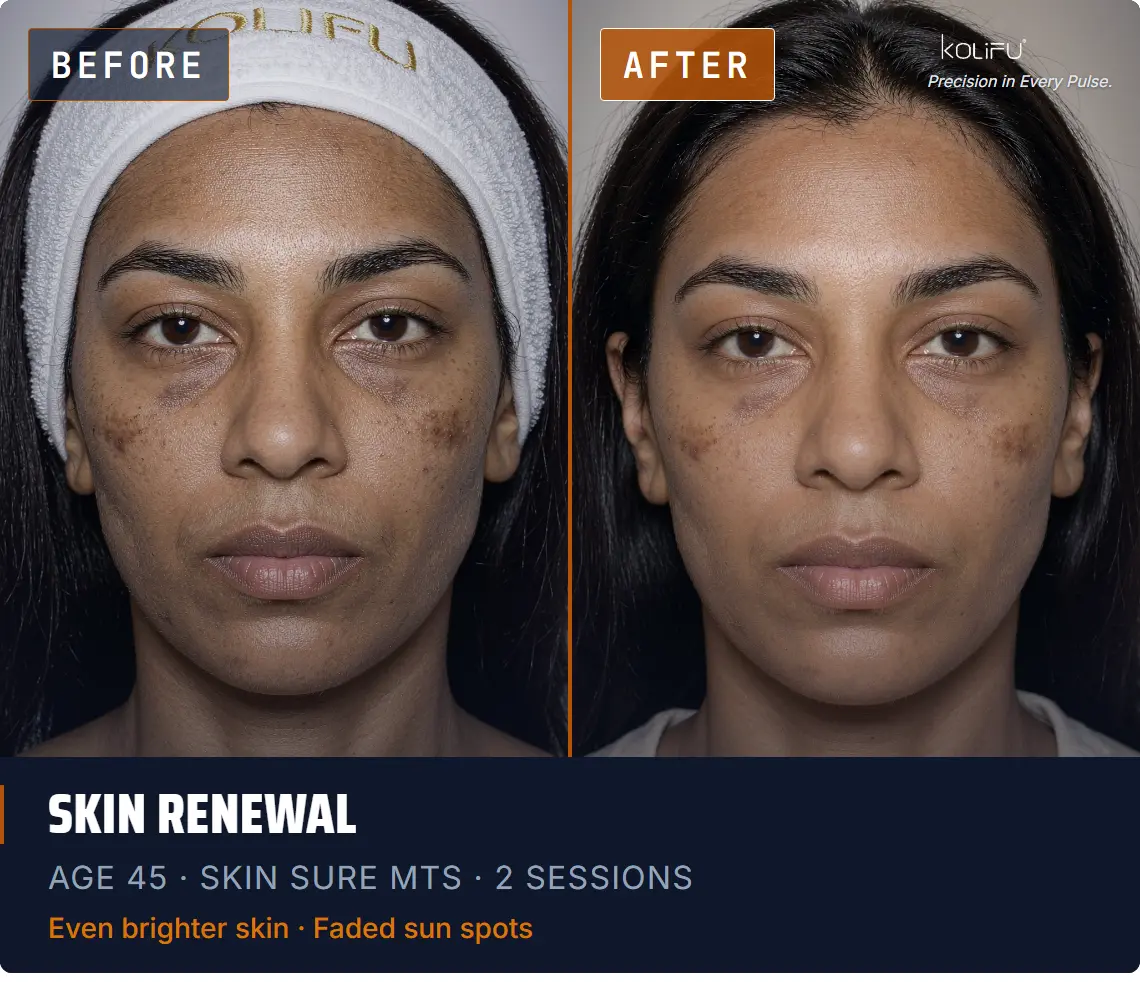 SKIN SURE MTS antes y después