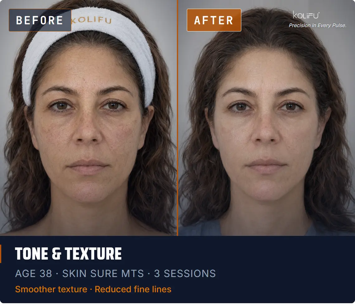 SKIN SURE MTS antes y después