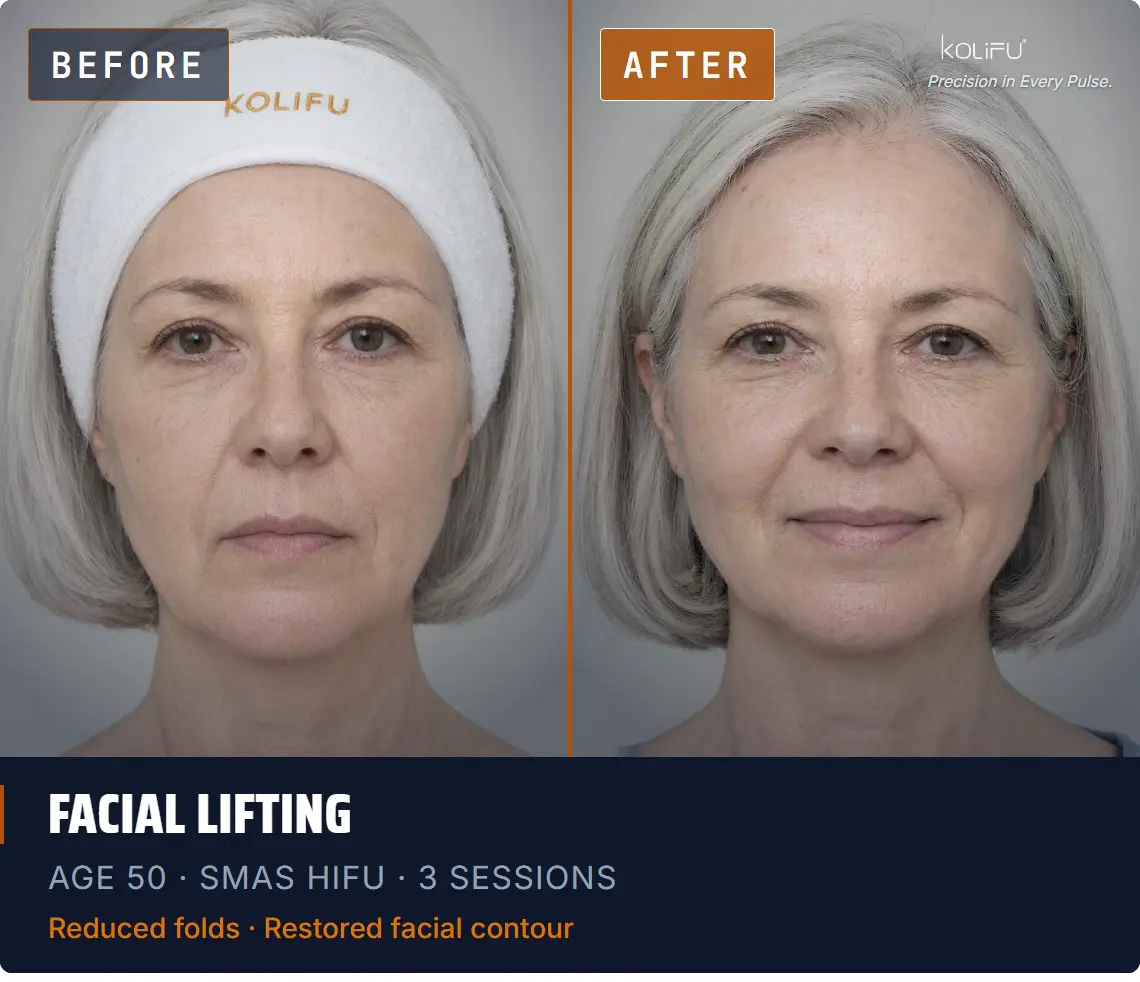 SMAS HIFU antes y después