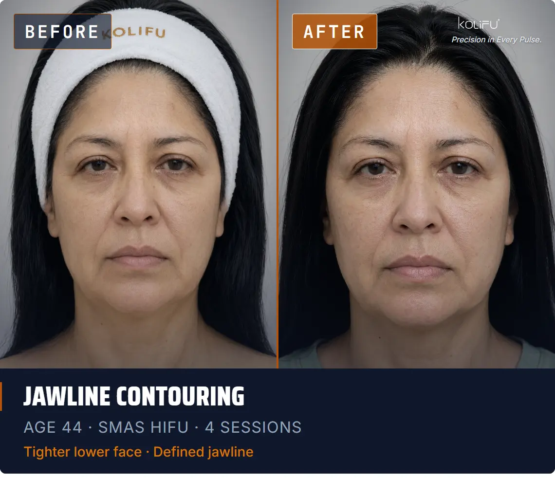SMAS HIFU antes y después
