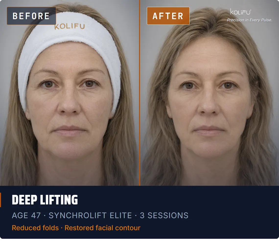 KOLIFU SYNCHROLIFT™ HIFU-RF ELITE antes y después