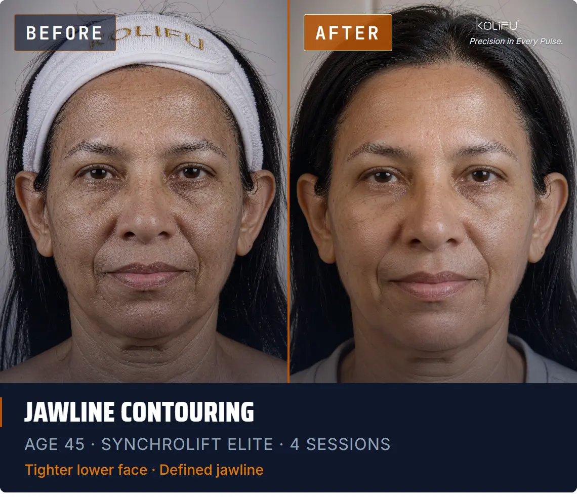KOLIFU SYNCHROLIFT™ HIFU-RF ELITE antes y después