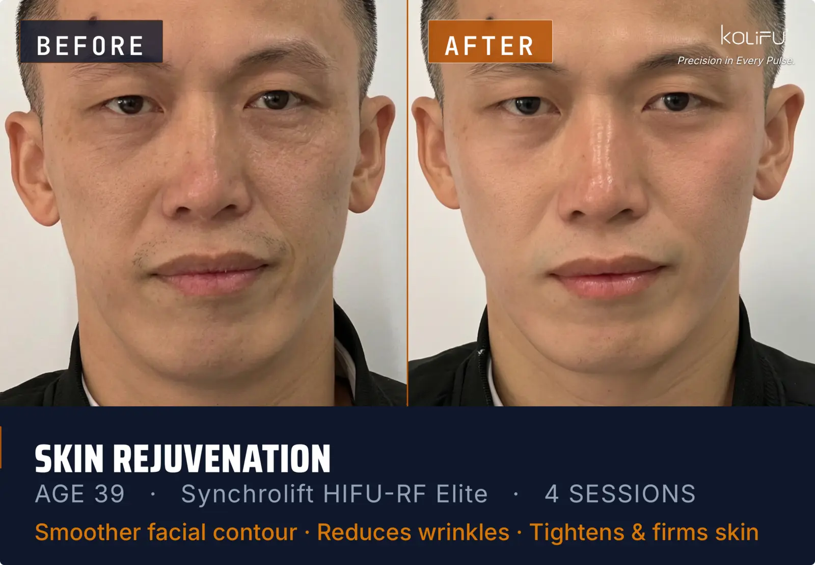 KOLIFU SYNCHROLIFT™ HIFU-RF ELITE antes y después