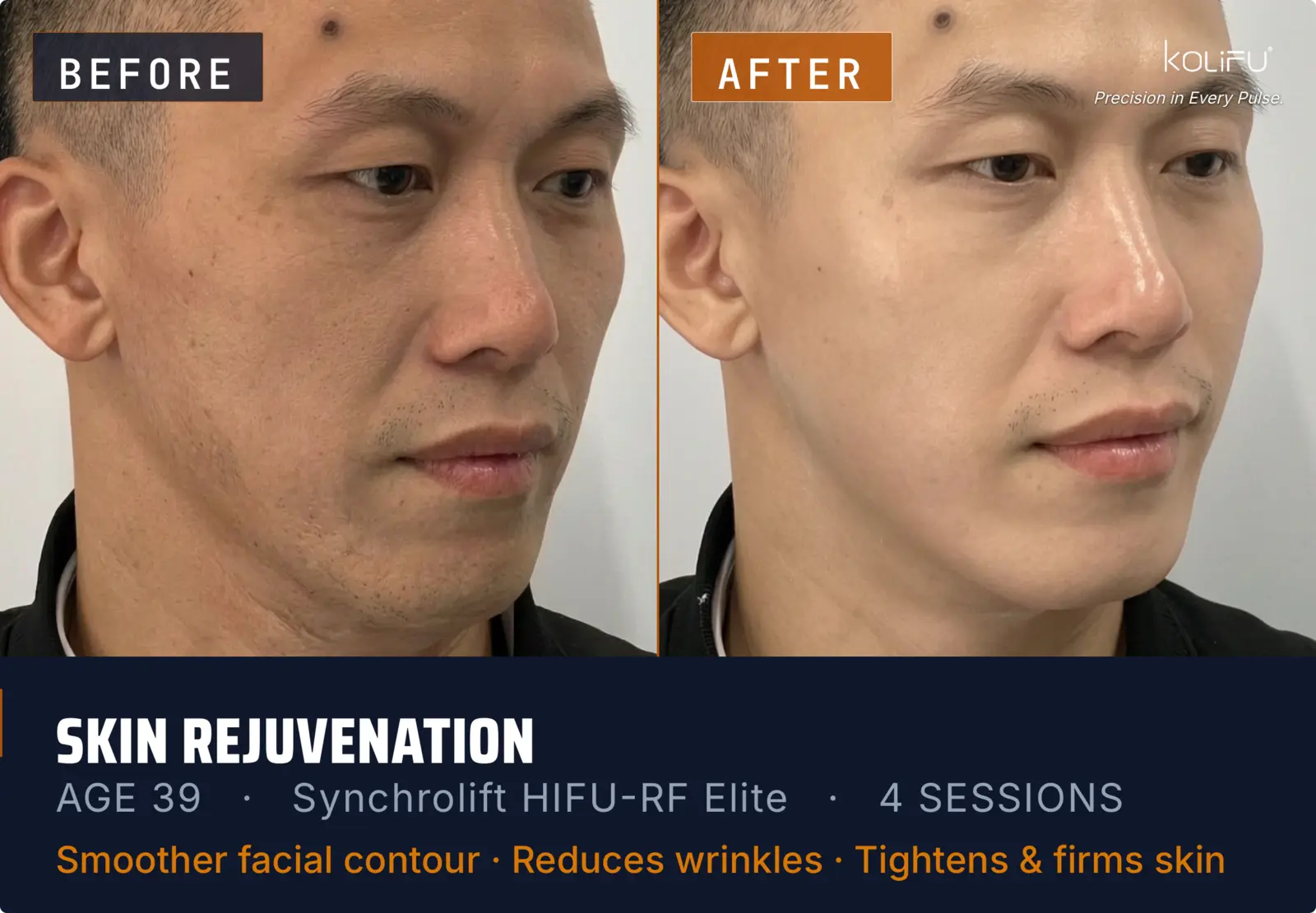 KOLIFU SYNCHROLIFT™ HIFU-RF ELITE antes y después