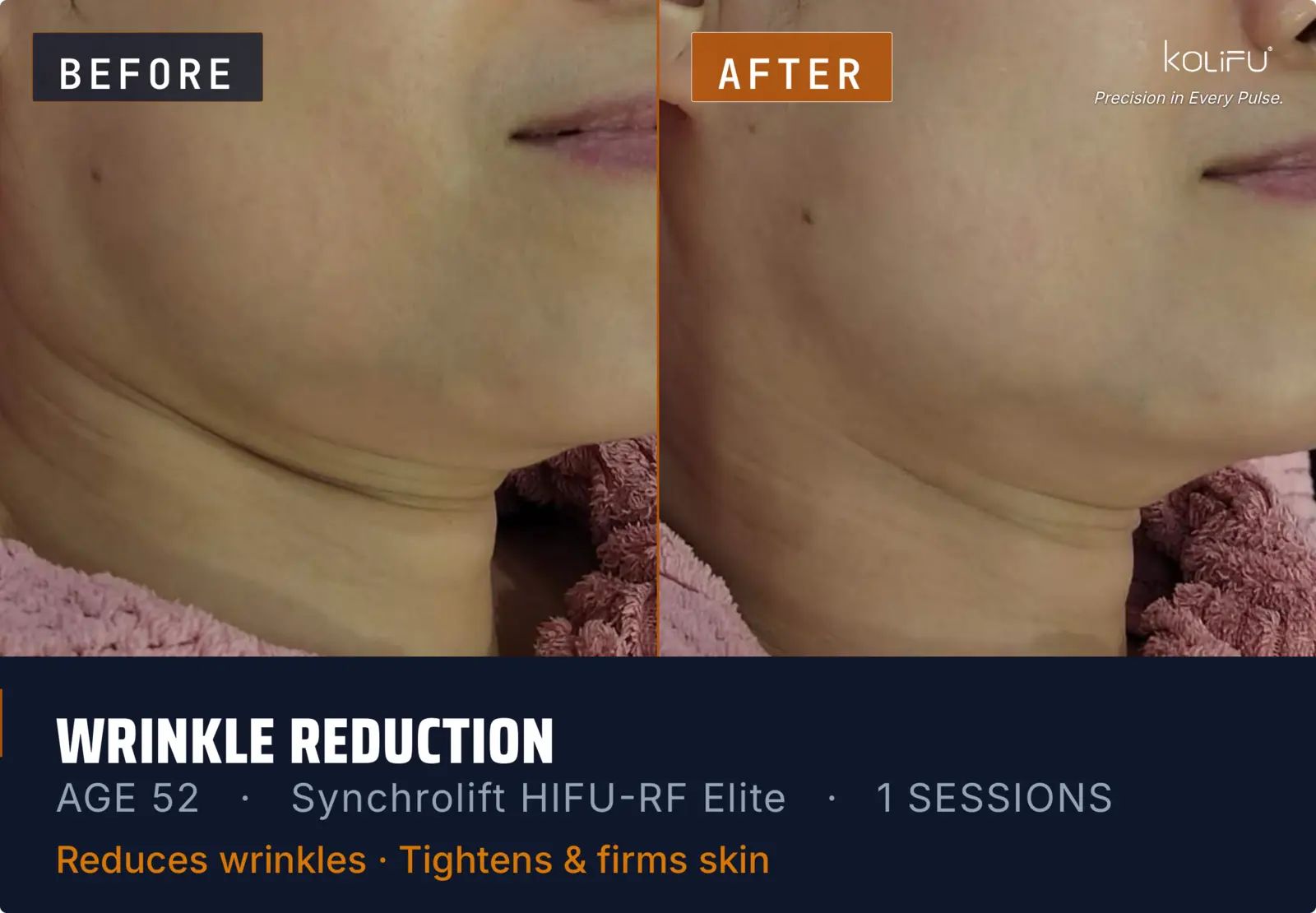 KOLIFU SYNCHROLIFT™ HIFU-RF ELITE antes y después