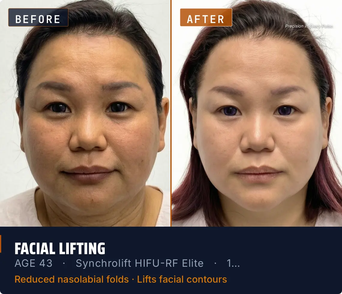 KOLIFU SYNCHROLIFT™ HIFU-RF ELITE antes y después