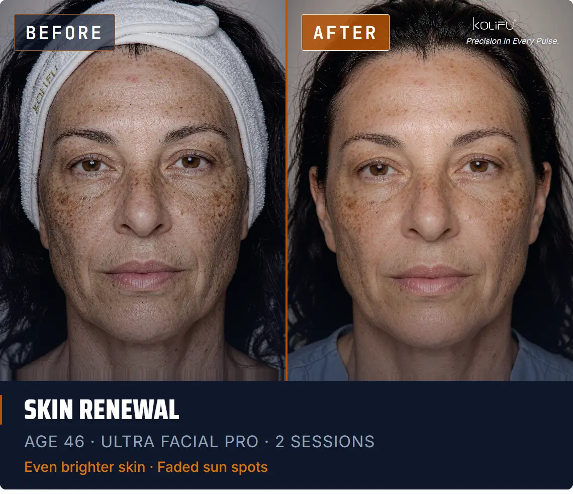 ULTRA FACIAL PRO antes y después