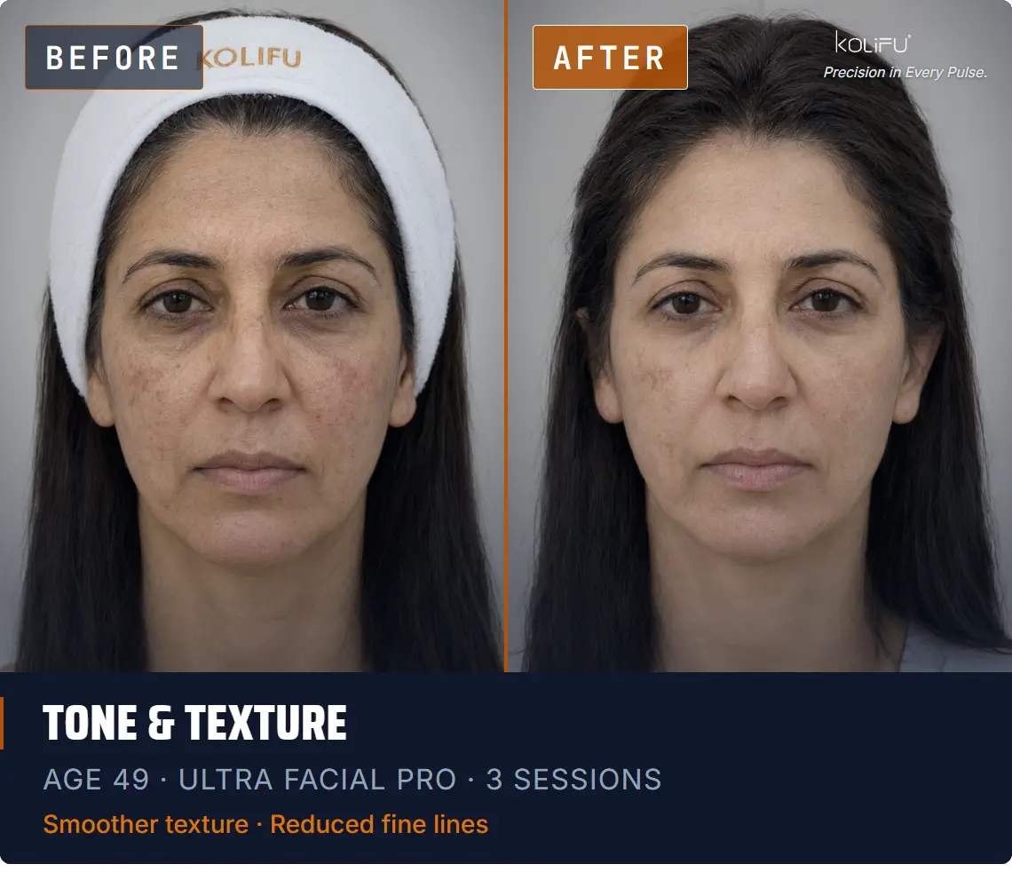 ULTRA FACIAL PRO antes y después