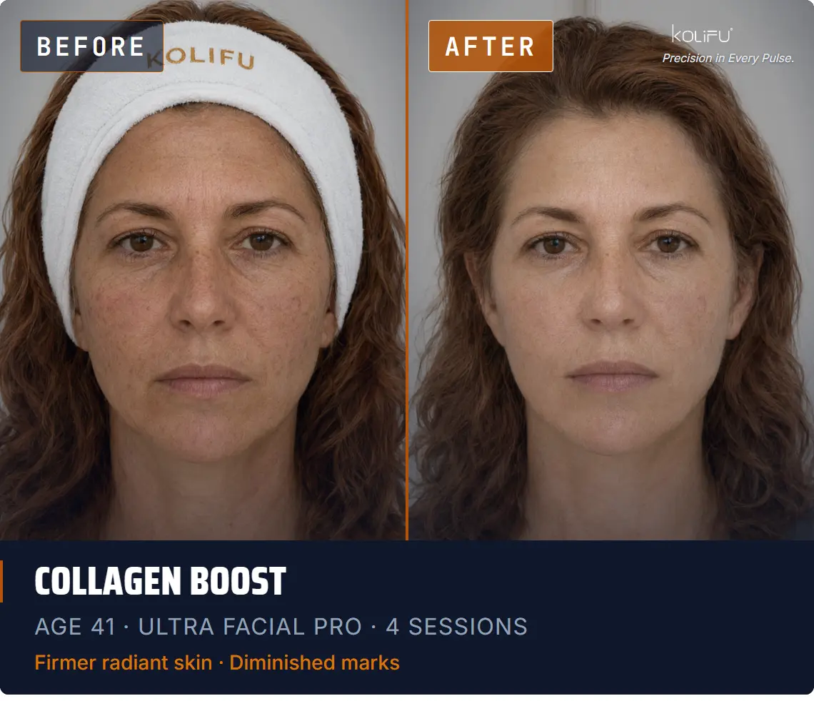 ULTRA FACIAL PRO antes y después