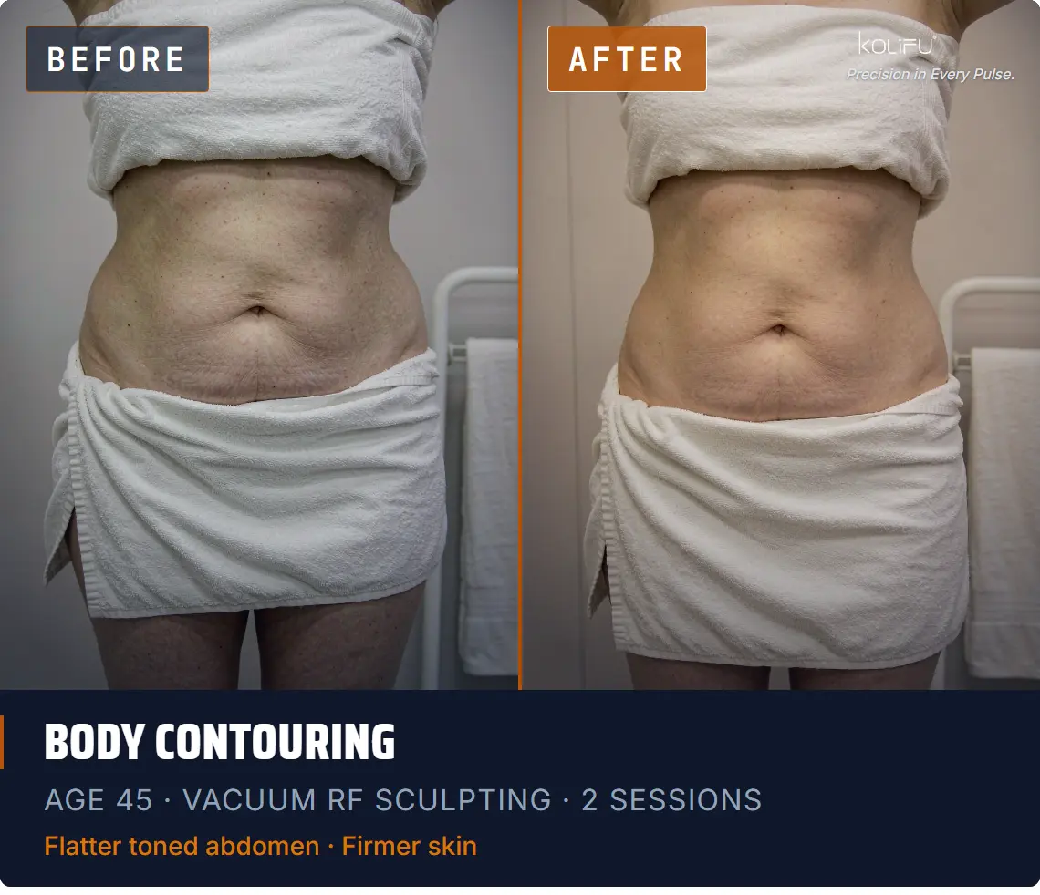 VACUUM RF SCULPTING antes y después