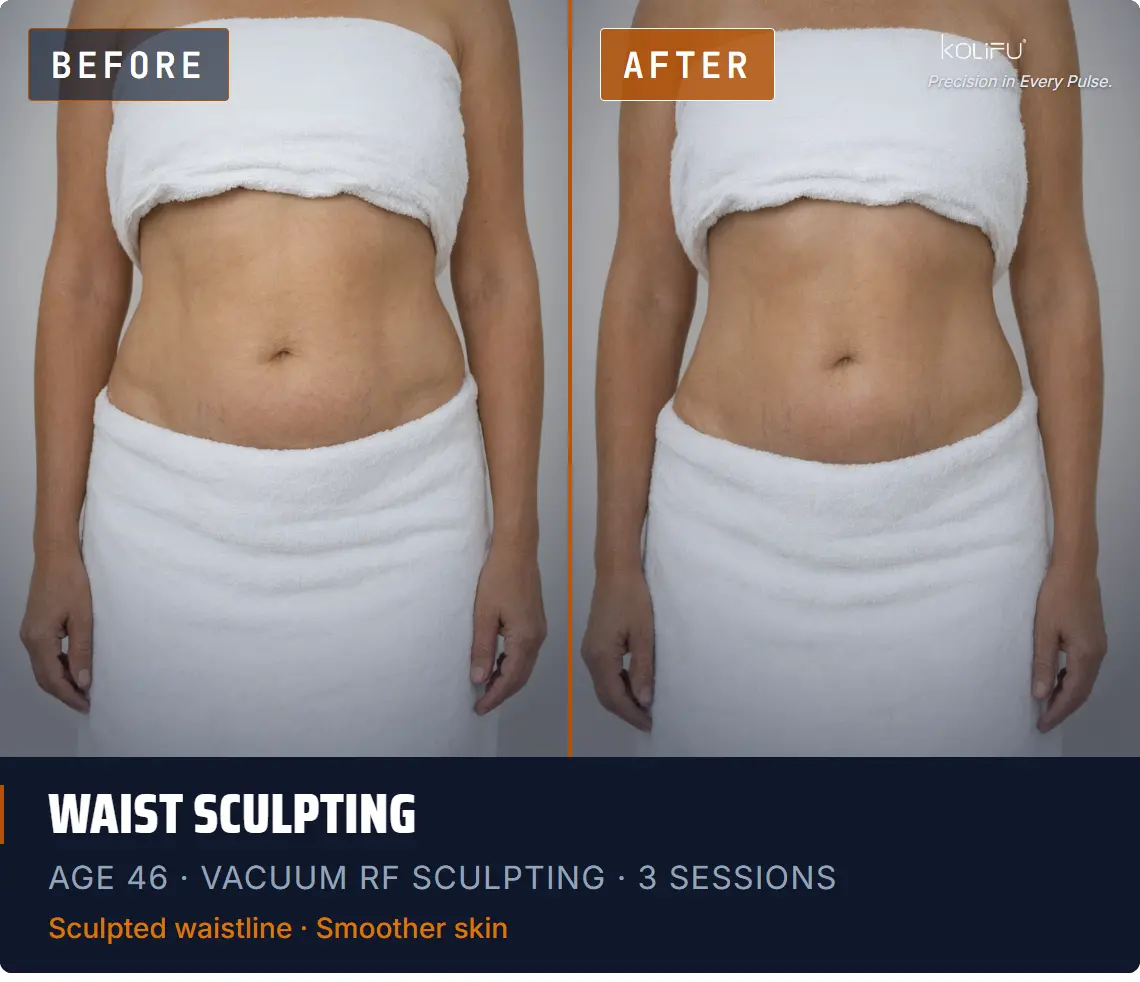VACUUM RF SCULPTING antes y después